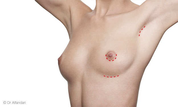 zone pour l'implant des prothèses mammaires