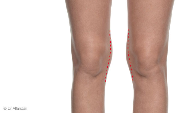 zones de liposuccion des genoux